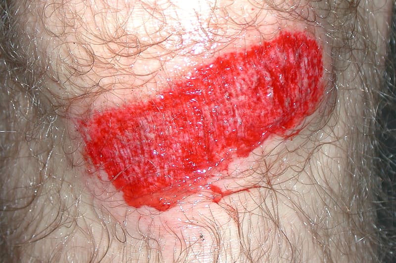 Scraped knee